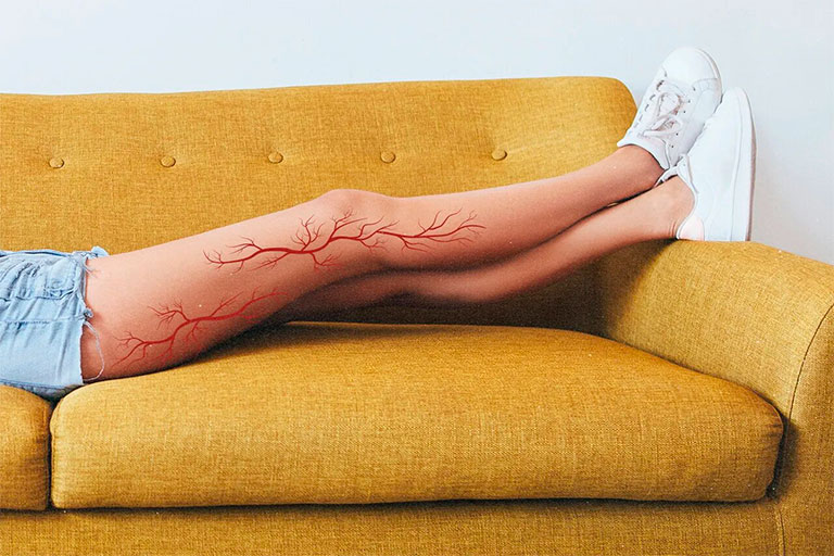 Рисунок варикозных вен на ногах